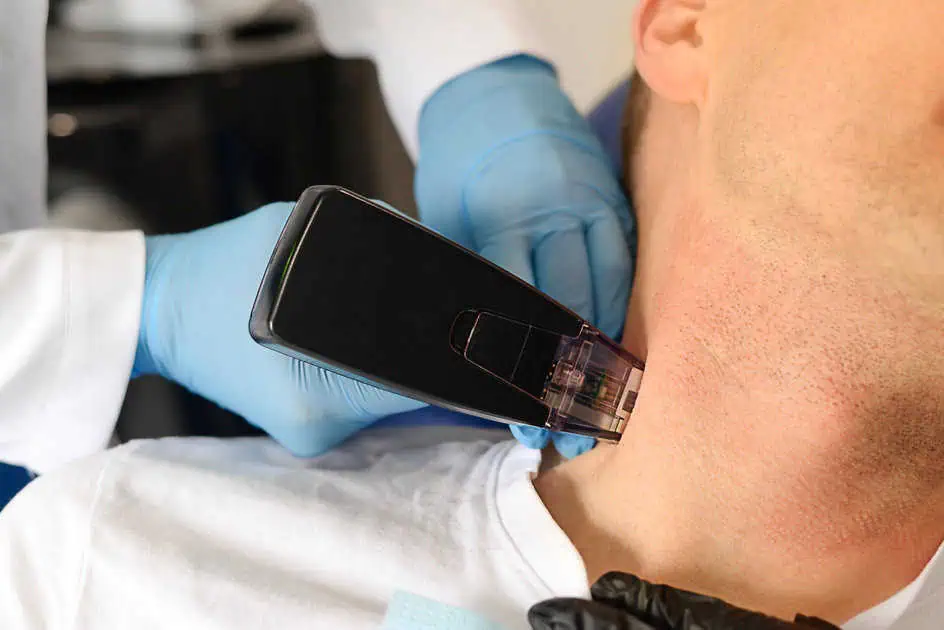 Why is Morpheus8 the Top Skin Rejuvenation Treatment?