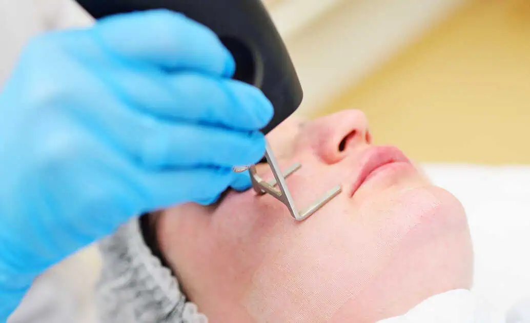 Is DEKA CO2 Laser the Best Treatment for Deep Acne Scars?